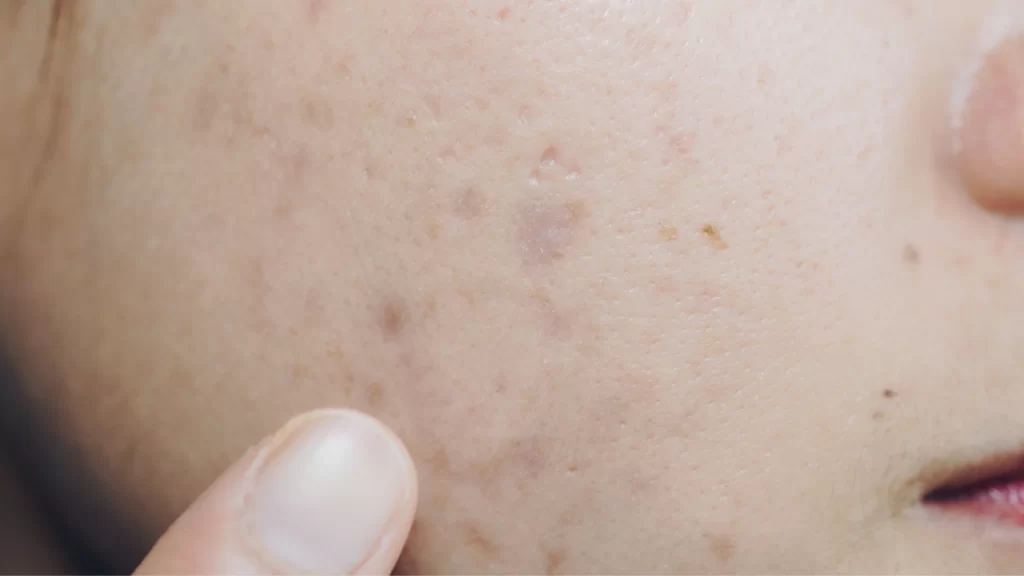 acne marks